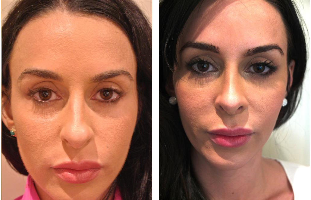 Best plastic surgeon rhinoplasty before and after