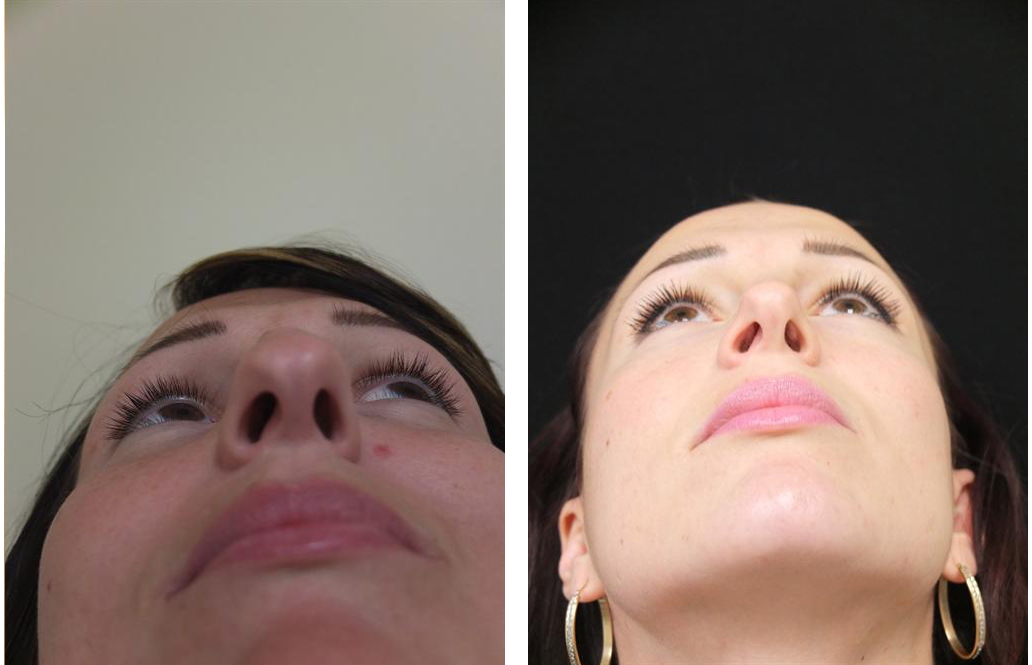 up nose view of before and after nosejob by Toronto plastic surgeon