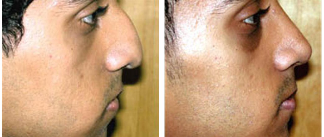 before and after male rhinoplasty photograph