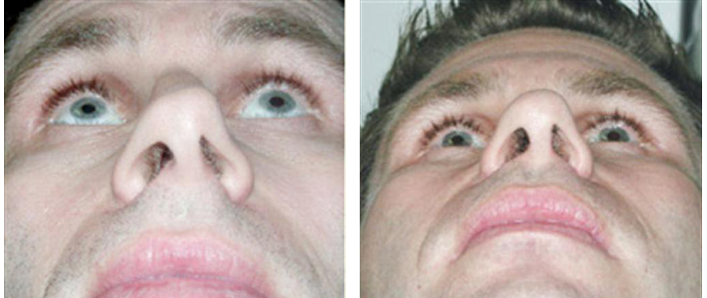 up the nose view of nosejob before and after of toronto male patient