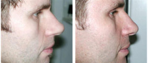 plastic surgery toronto before and after photos of a rhinoplasty
