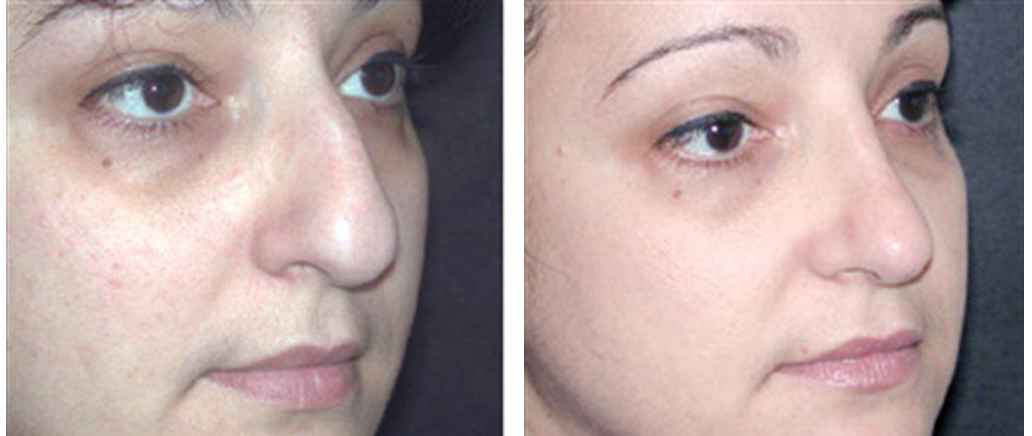 before and after female rhinoplasty by dr. richard rival