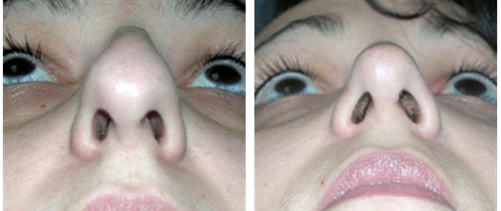 Toronto before and after female rhinoplasty by dr. richard rival