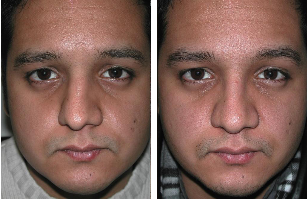 Toronto rhinoplasty on tanned skinned man