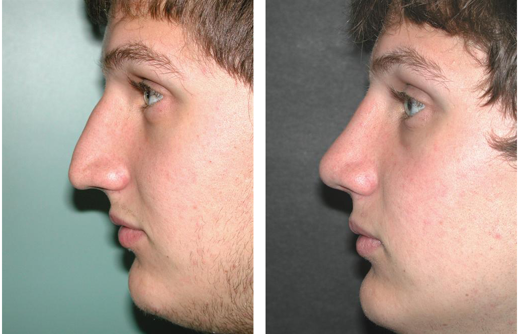 male nosejob before and after photos by Dr. Richard Rival