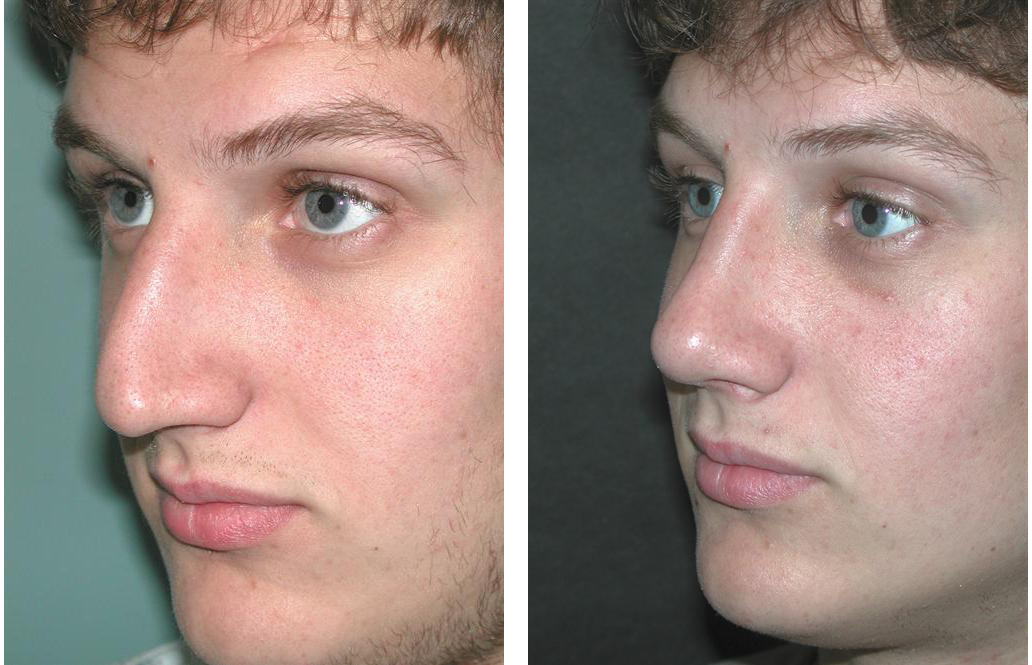 side angle of toronto rhinoplasty by Dr. Rival of the Plastic Surgery Skin Clinic