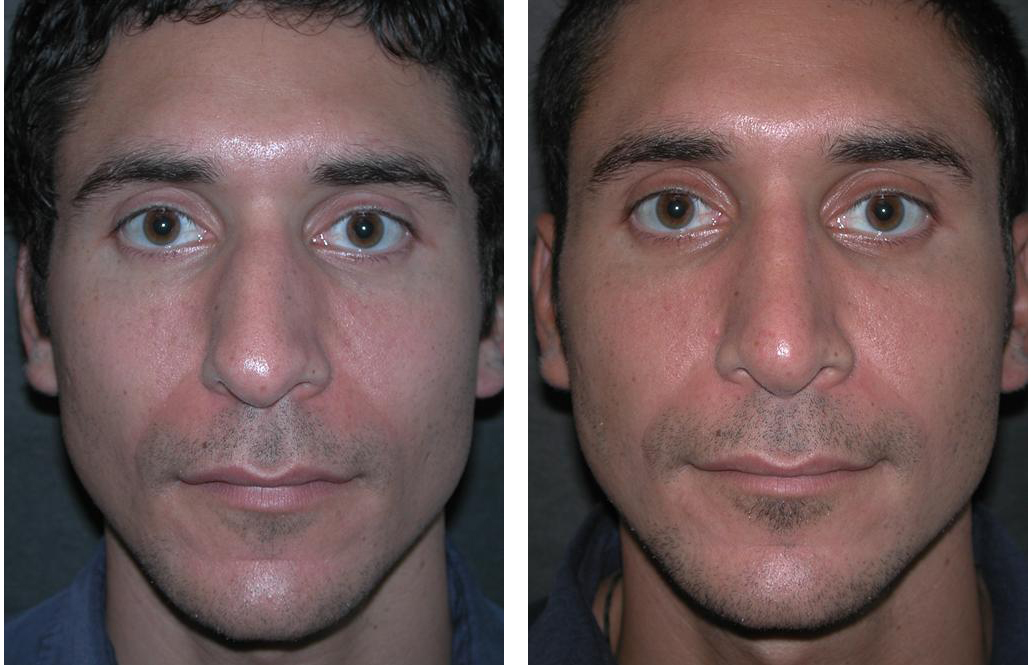 front view of toronto rhinoplasty on male