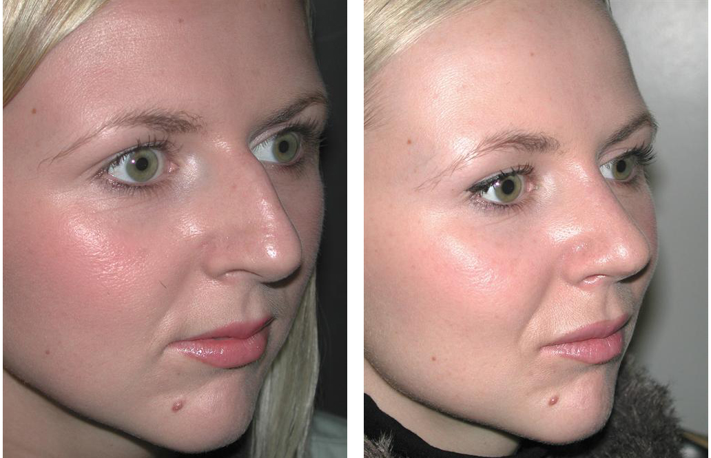 before and after photos of side angle view of female rhinoplasty in toronto
