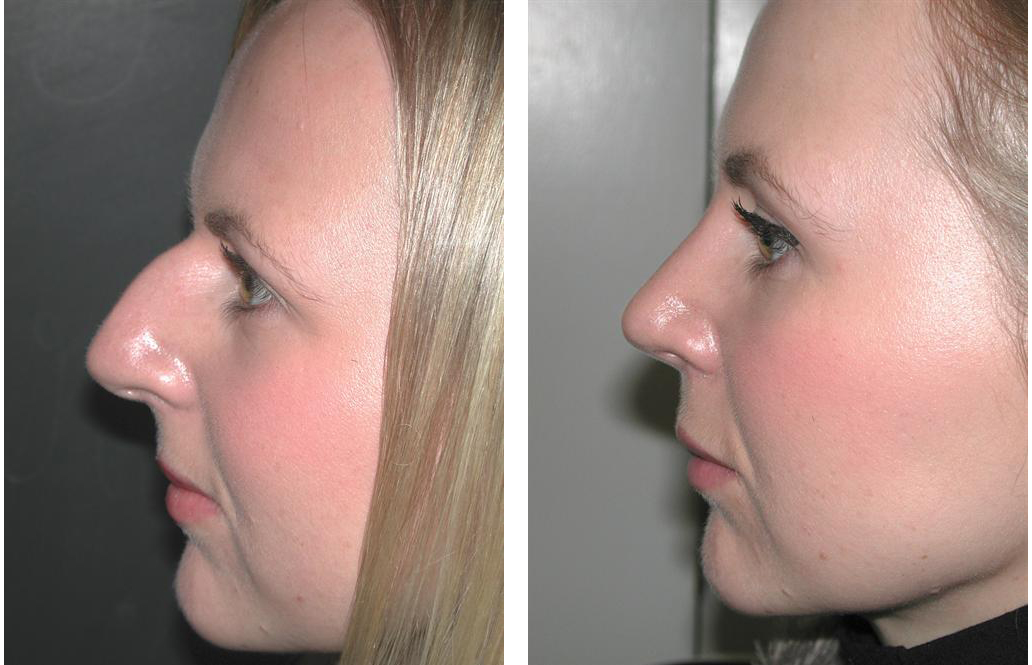 before and after photos of female rhinoplasty in toronto