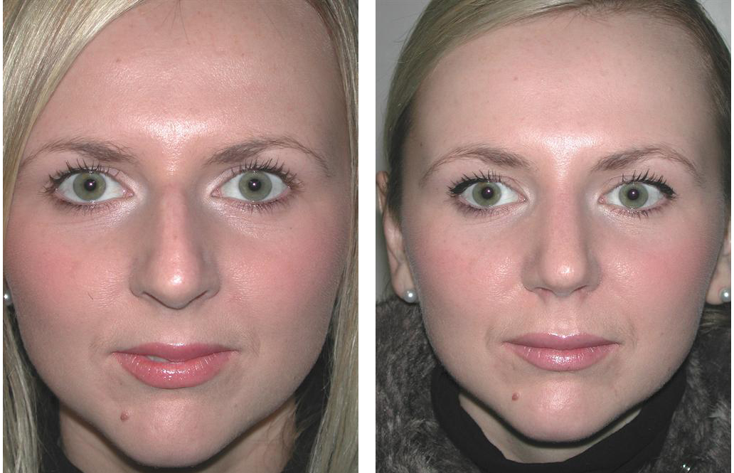 toronto rhinoplasty before and after photos