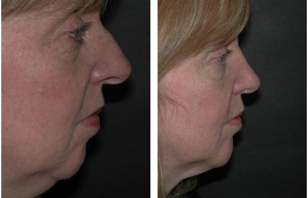 middle aged rhinoplasty on Toronto woman by Dr. RIval