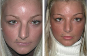 toronto rhinoplasty before and after on female patient with blonde hair