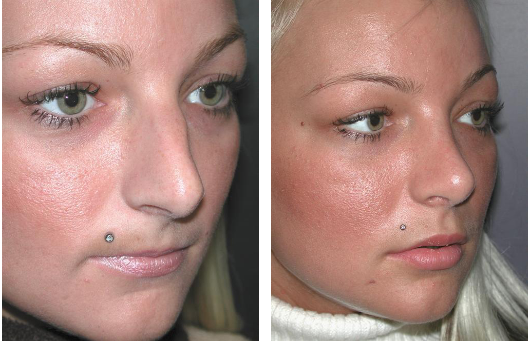 side view of toronto rhinoplasty before and after on female 