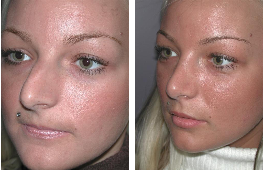 angle view of toronto rhinoplasty before and after on female 