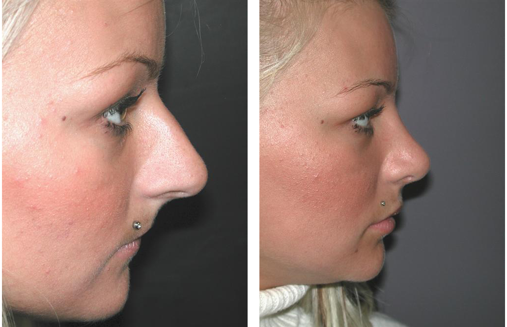 right side view of toronto rhinoplasty before and after on female patient with blonde hair