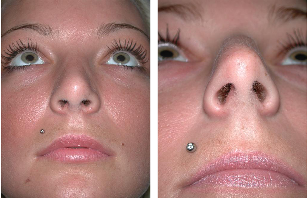 up nose angle of toronto rhinoplasty before and after on female patient