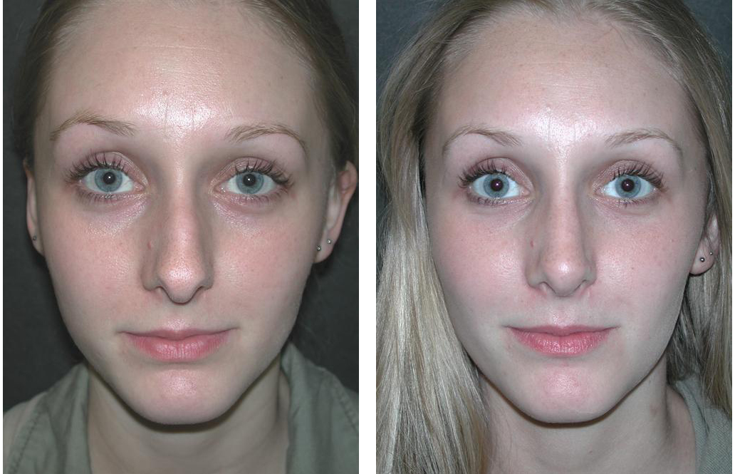 newmarket nosejob before and after by dr. rival