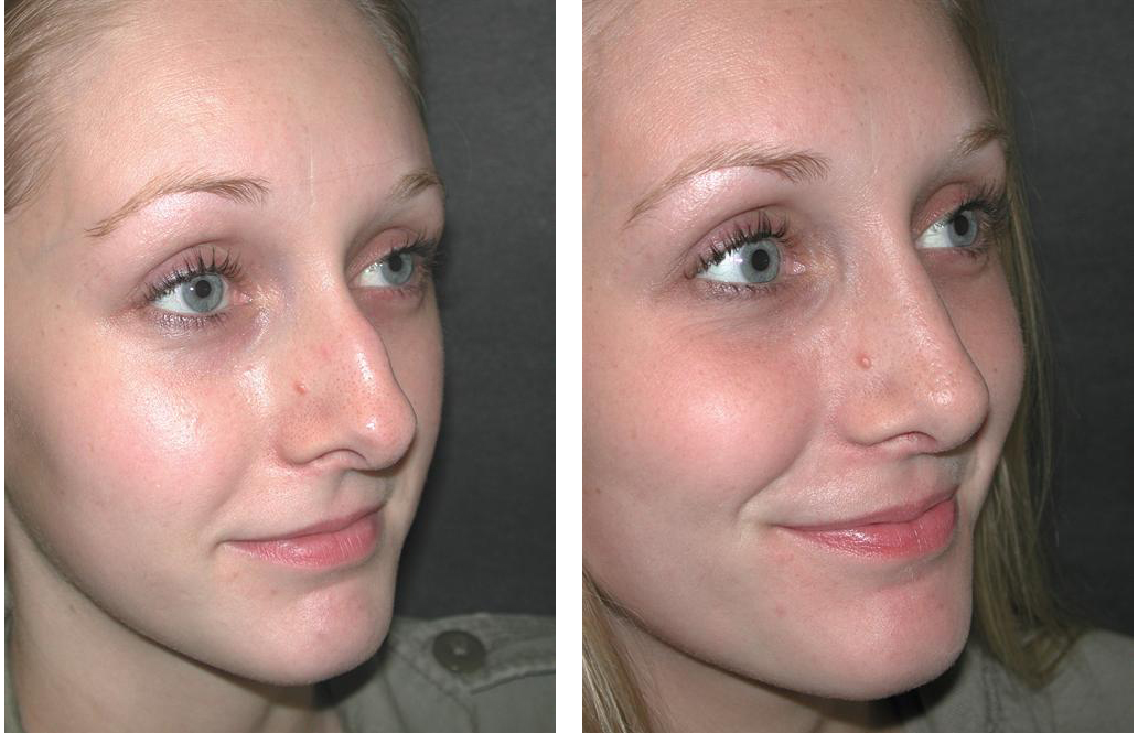 toronto nosejob before and after of female patient in toronto