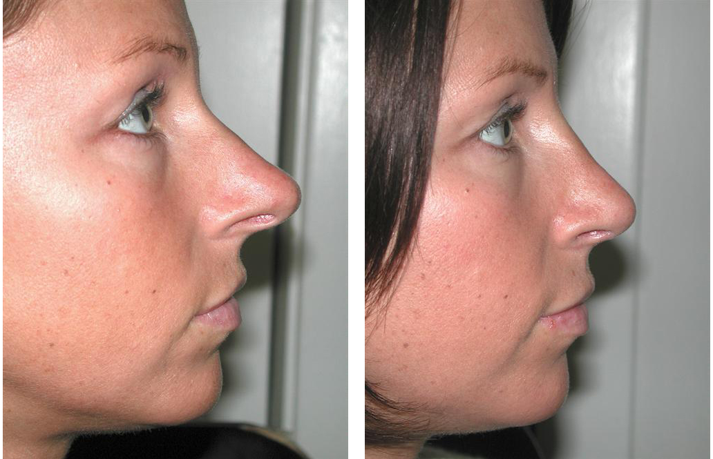 bridge fixed in rhinoplasty by dr. richard rival of toronto and newmarket