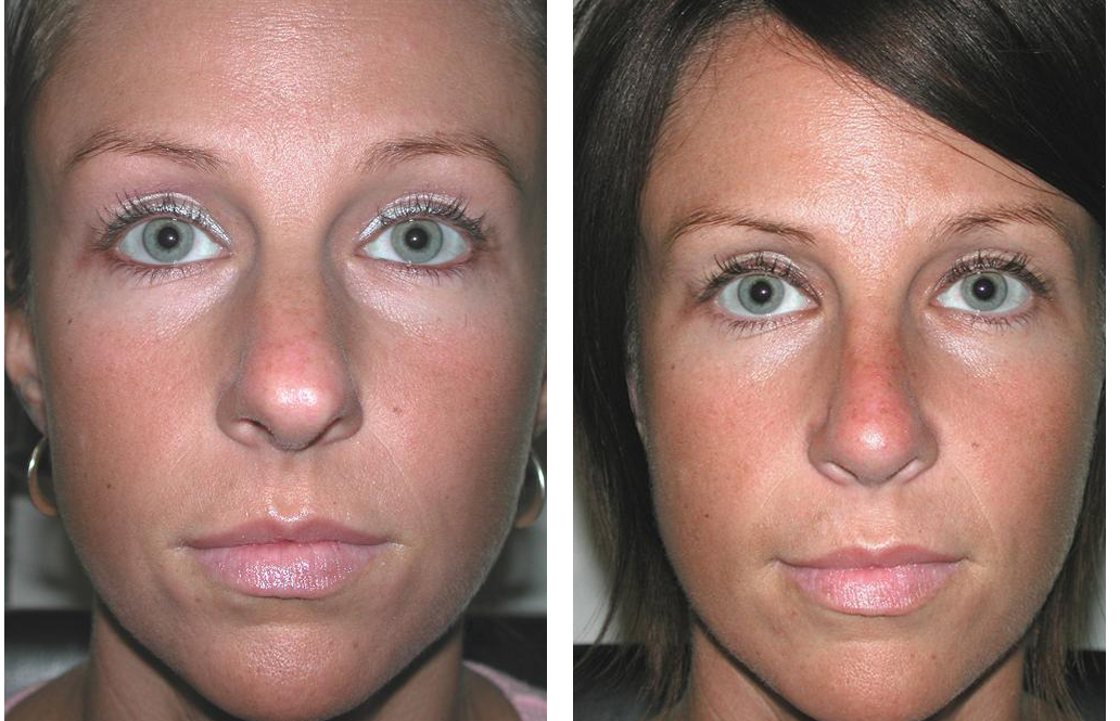 toronto rhinoplasty by Dr. Rival of the Plastic Surgery Skin Clinic
