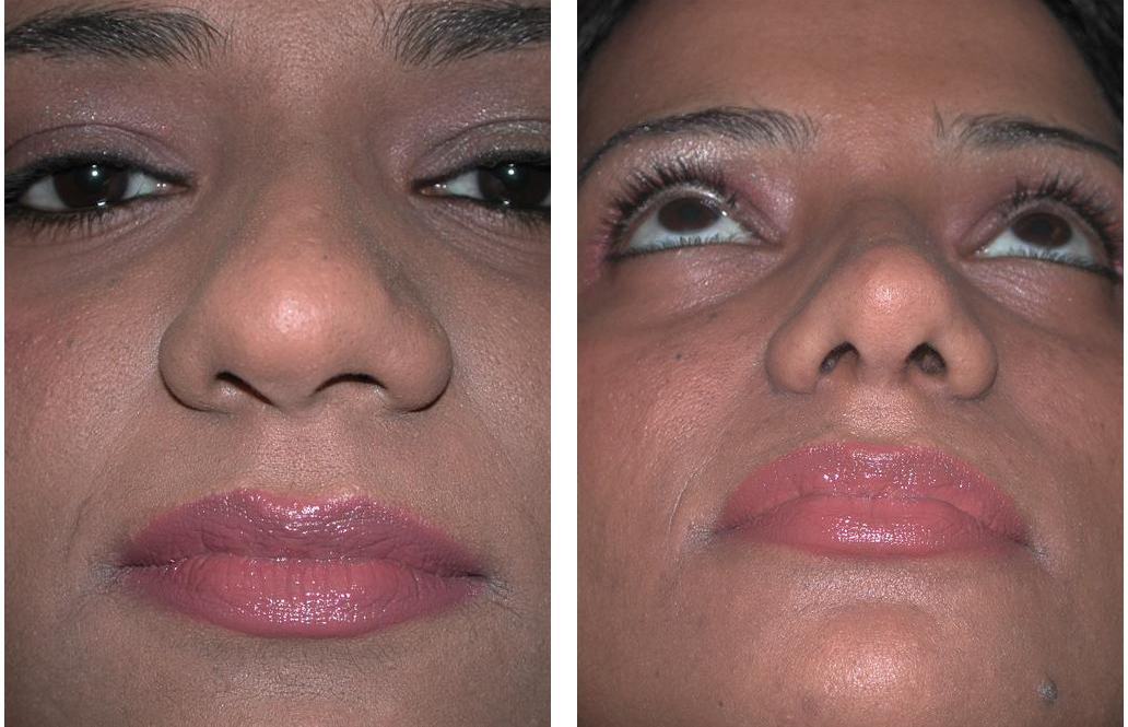 female nosejob altered by facial plastic surgeon Dr. Richard Rival