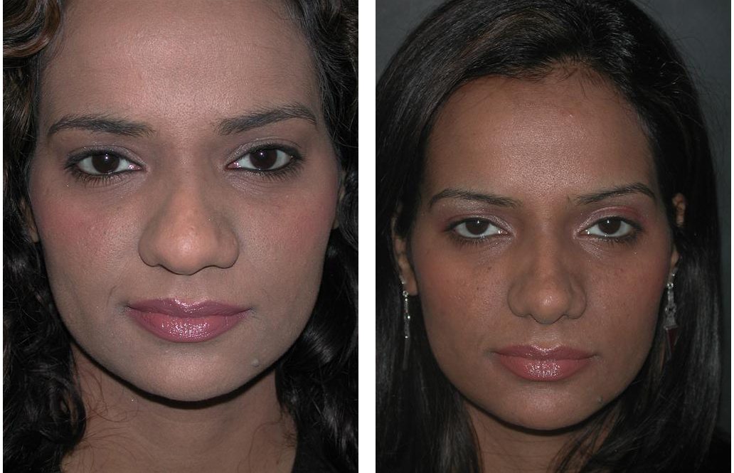 female rhinoplasty done by facial plastic surgeon Dr. Richard Rival