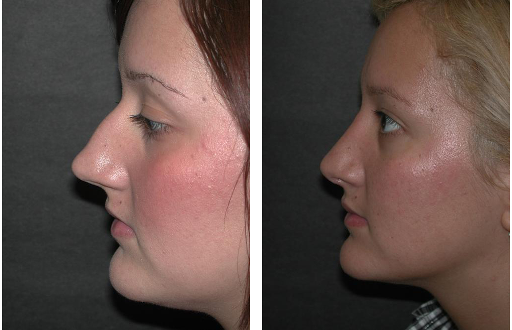 Before and after Toronto Rhinoplasty done by Dr. Richard Rival