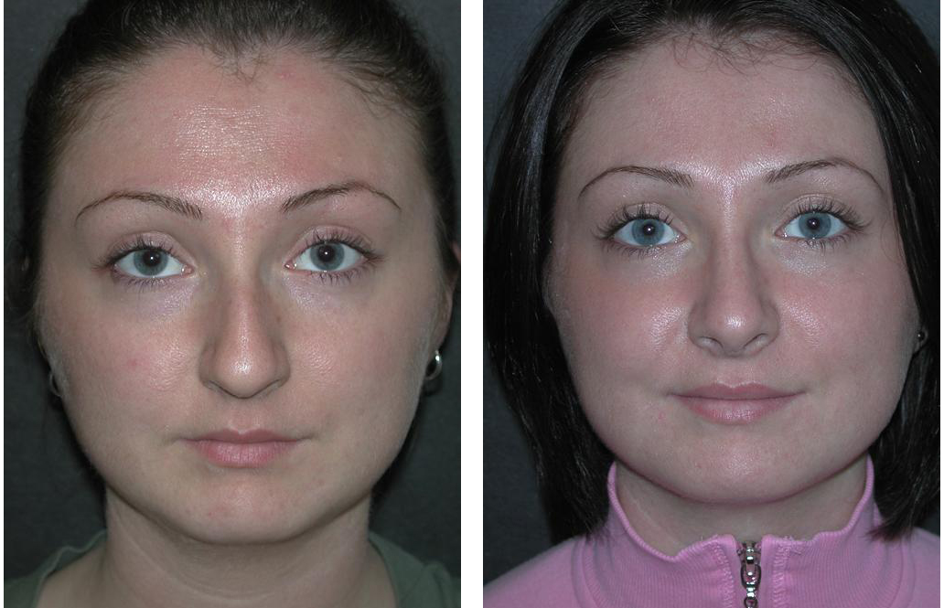Before and After Rhinoplasty by Toronto cosmetic surgeon Dr. Rival