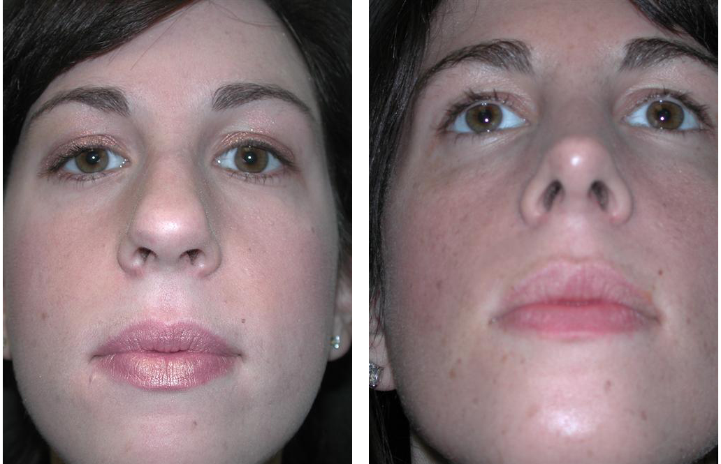 Rival cosmetic surgery nosejob on female patient
