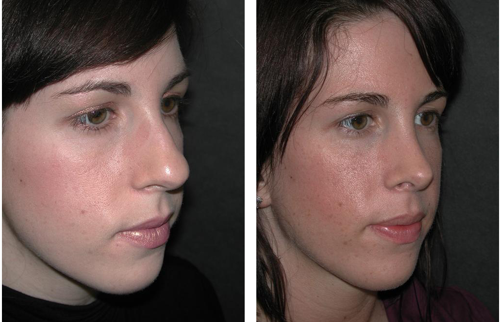 Nose job before and after by Dr. Richard Rival