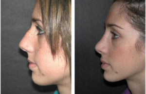 Young female nose job done by Toronto plastic surgeon Richard Rival