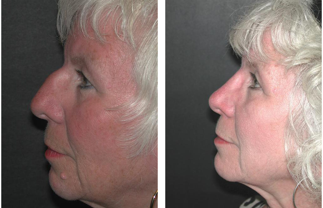 elder female nosejob done by Toronto plastic surgeon Dr. Richard Rival