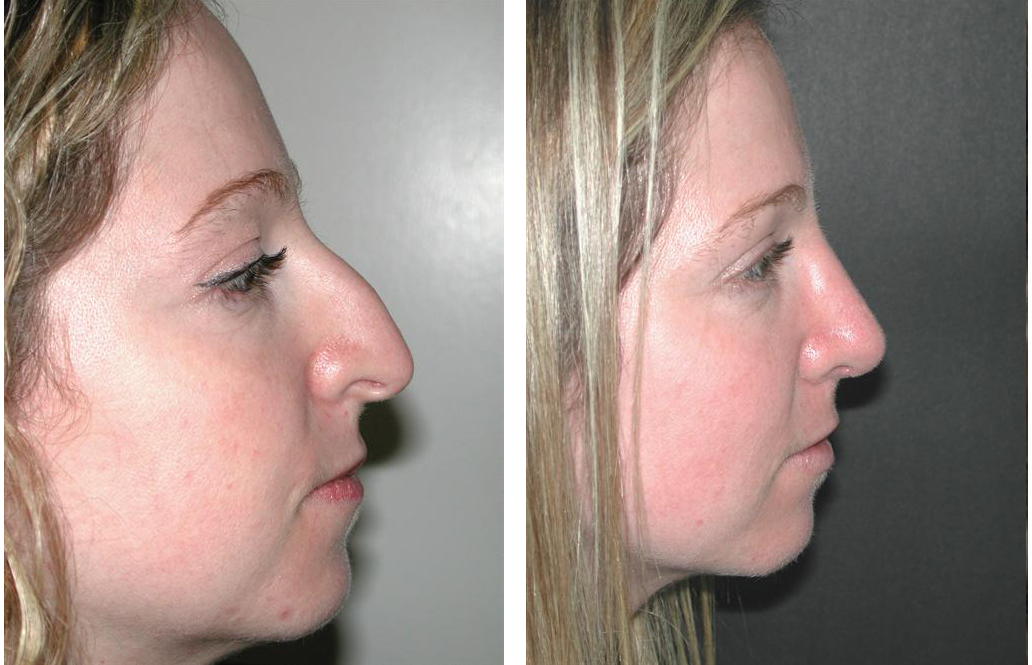 Facial Cosmetic Surgeon Dr. Richard Rival's before and after rhinoplasty