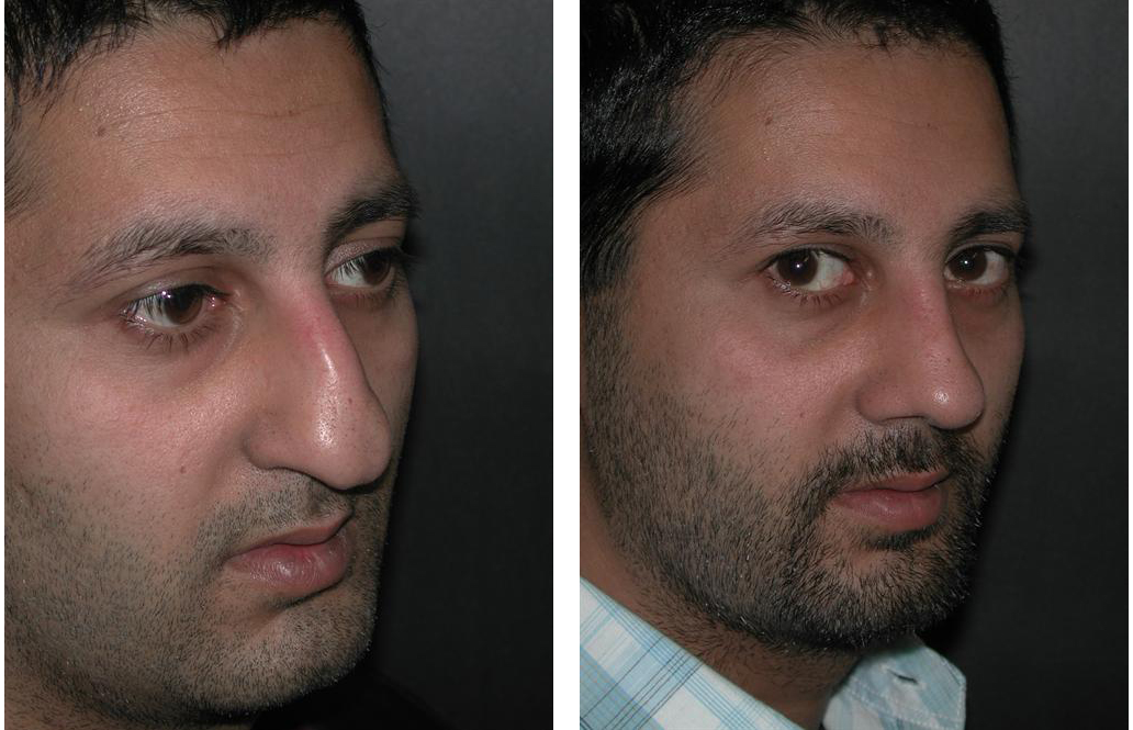 male before and after photos of rhinoplasty by Dr. Richard Rival
