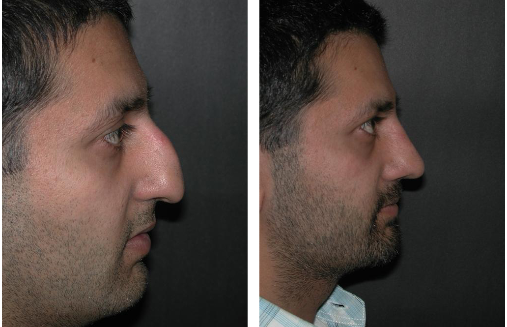 Dr. Richard Rival's rhinoplasty work in before and after nosejob photos