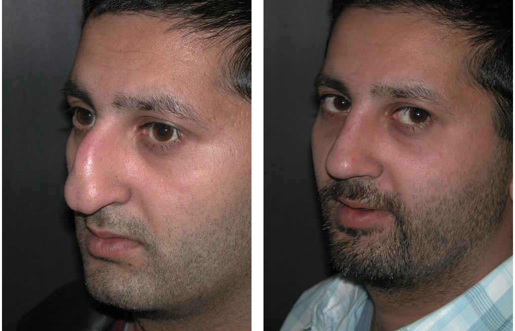 Toronto rhinoplasty by facial cosmetic surgeon Dr. Richard Rival