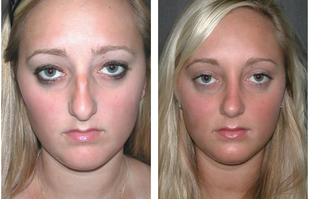 Blonde female rhinoplasty done by Toronto plastic surgeon Dr. Rival