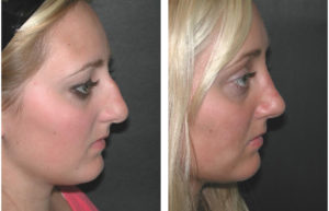 Side view of female nosejob done by Toronto plastic surgeon Dr. Richard RIval