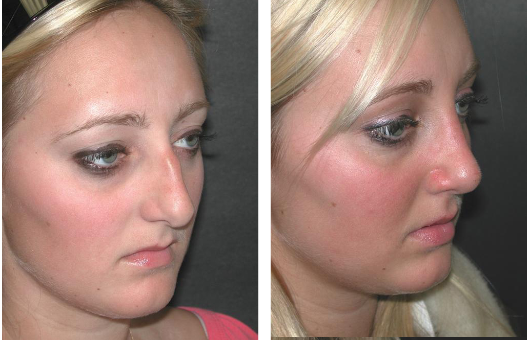 Nose job before and after photos by Toronto facial cosmetic surgeon Dr. Richard Rival