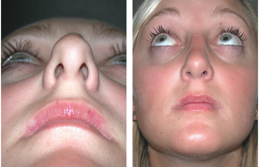 Before and After nose job photos by Newmarket plastic surgeon Dr. Richard Rival