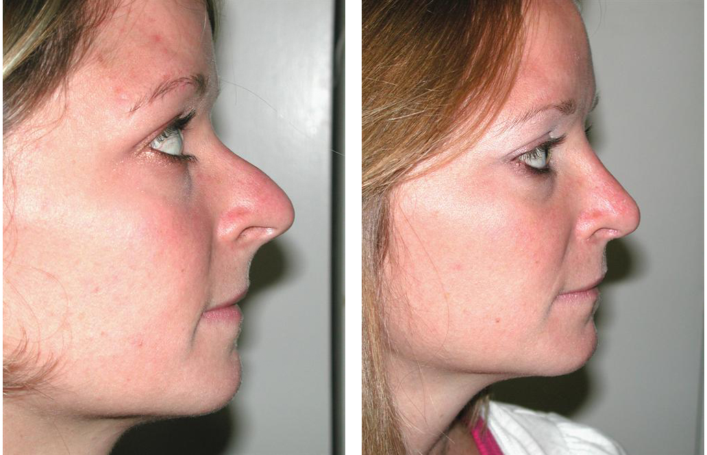 Sideview of toronto rhinoplasty by facial cosmetic surgeon Dr. Richard Rival