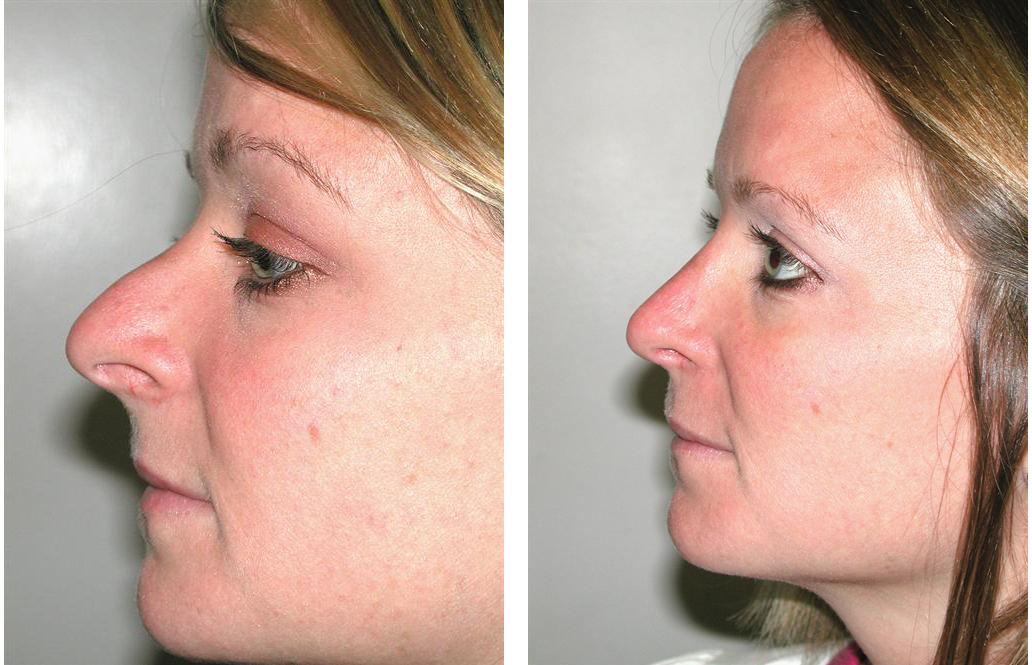 Rhinoplasty by best Newmarket Plastic Surgeon Dr. Richard Rival