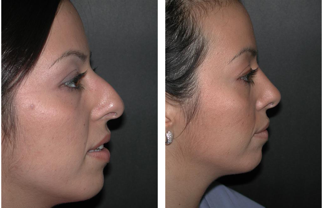 soothed bridge nose job on female by Dr. Rival of Toronto