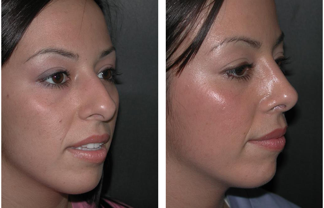 Rhinoplasty before and after by Richard Rival