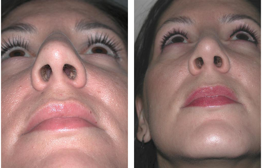 Before and after rhinoplasty by toronto cosmetic surgeon