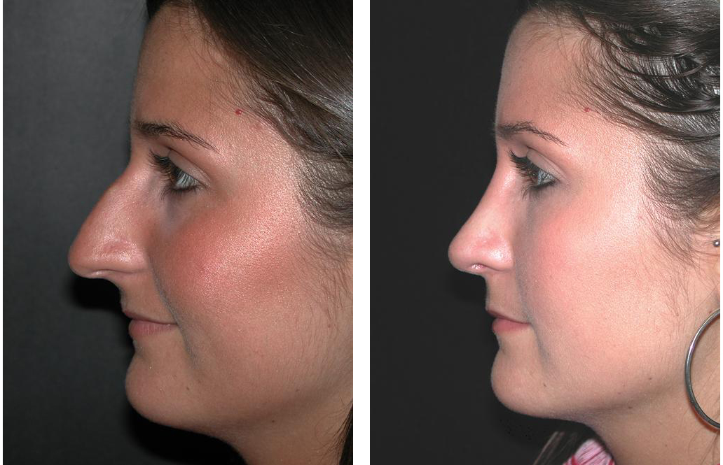 Before and after rhinoplasty by toronto surgeon