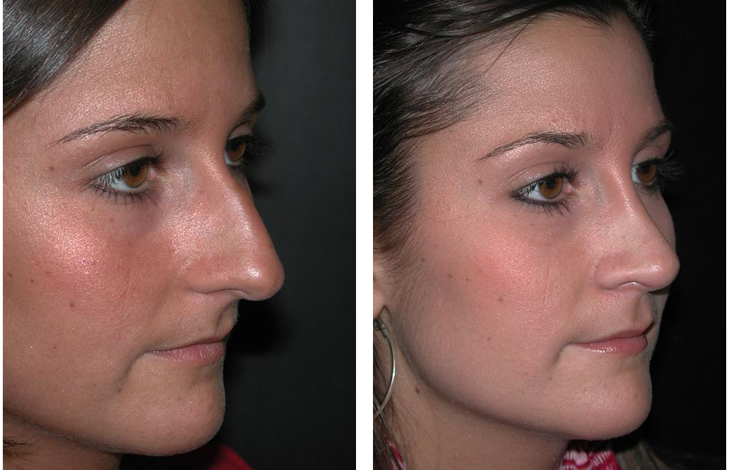 Toronto plastic surgeon's nosejob before and after