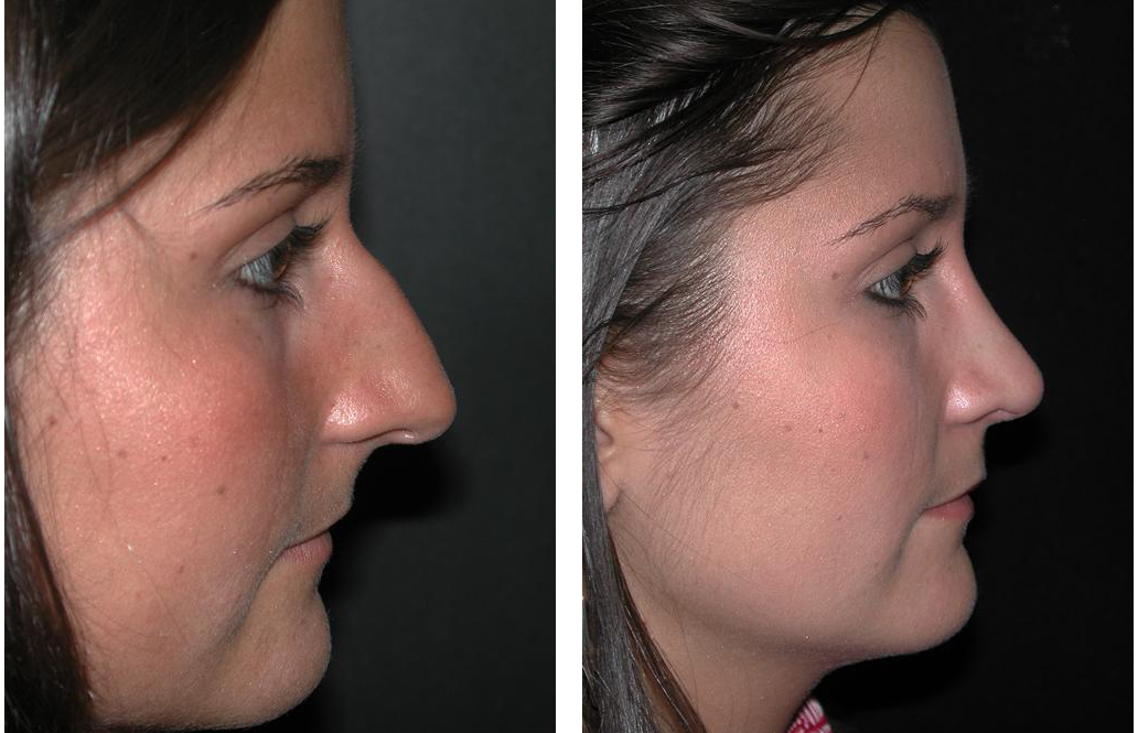 Nose job by toronto plastic surgeon