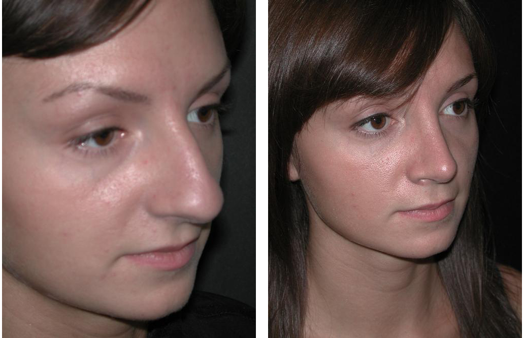 Stunning rhinoplasty performed by newmarket cosmetic surgeon Dr. Richard Rival