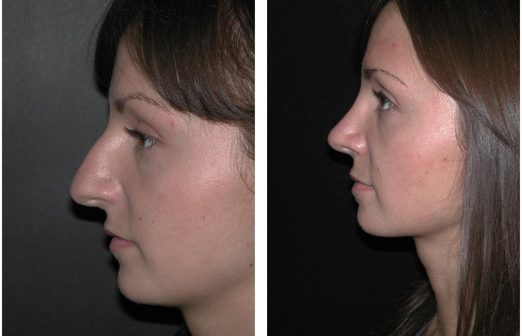 Newmarket Rhinoplasty by facial plastic surgeon Dr. Richard Rival